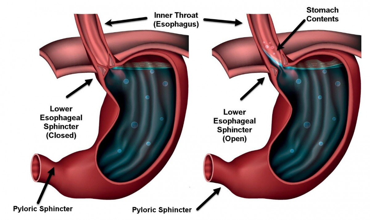 How I Cured My Silent Reflux The Acid Reflux Guy